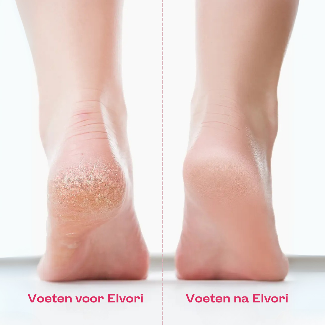 Elvori Eeltverwijderaar Pro 3